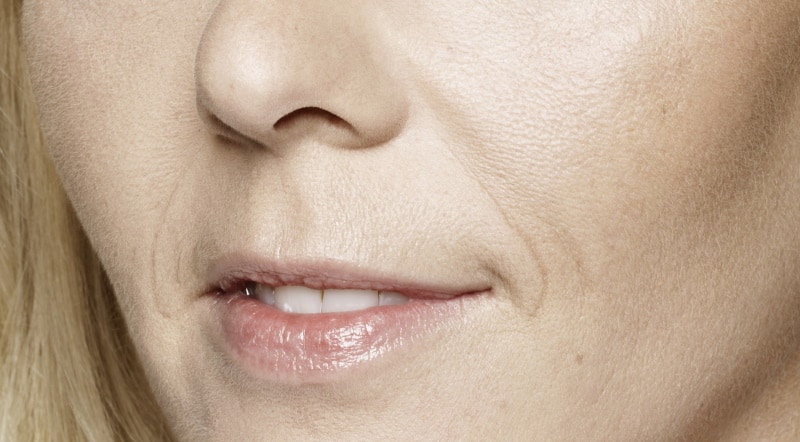Neus-lippenplooi voor