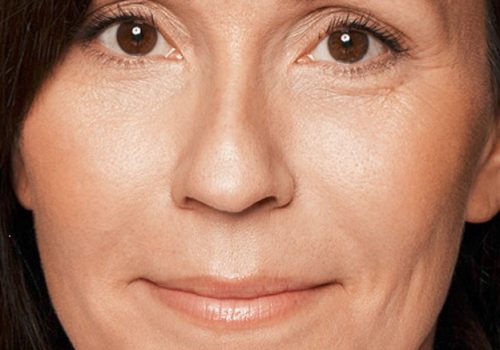 Vrouw wangen opvullen na