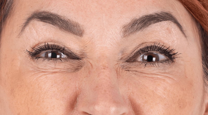 Bunny lines neusrimpels Marlies na, baby botox, mini botox