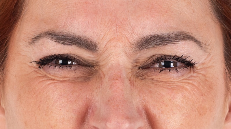 Bunny lines neusrimpels Marlies voor, Baby Botox, mini botox