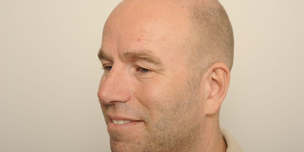 Bovenooglidcorrectie voor - Gido