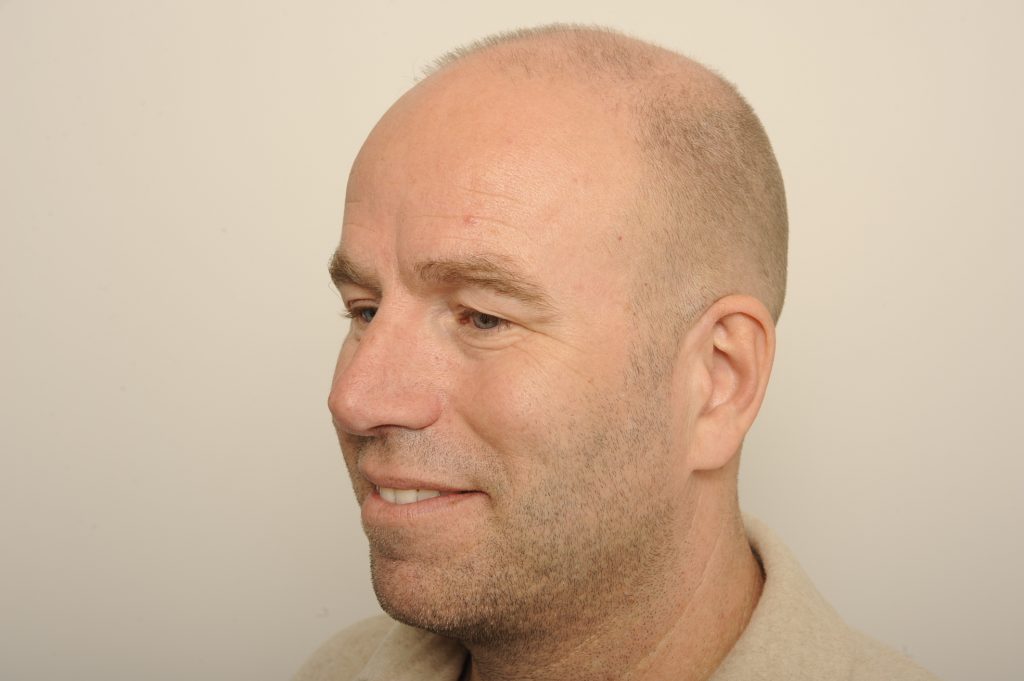 Bovenooglidcorrectie voor - Gido