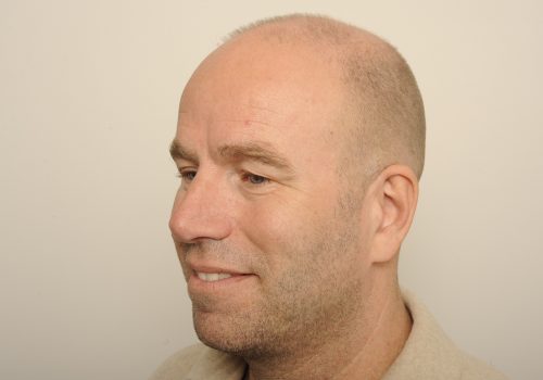 Bovenooglidcorrectie voor - Gido