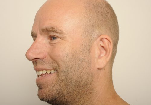 Ooglidcorrectie en wenkbrauwlift na - Gido