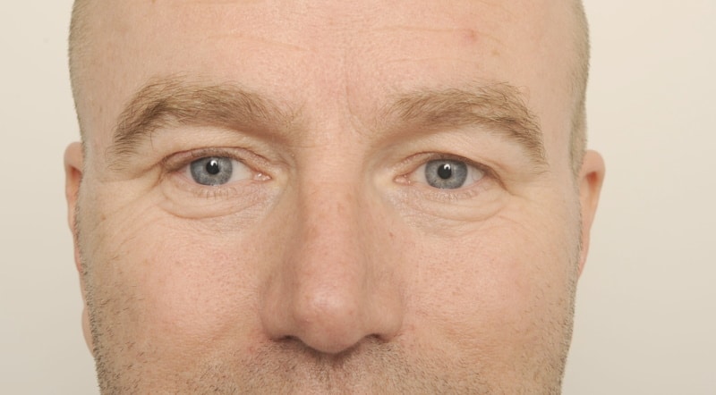 Guido - bovenooglidcorrectie met wenkbrauwlift - voor, wenkbrauwfixatie, wenkbrauwen fixeren