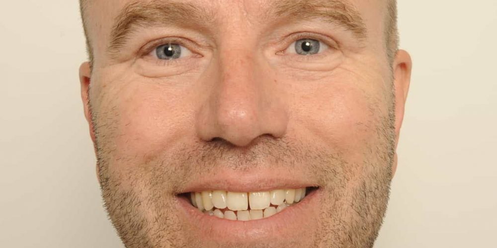 Na de ooglidcorrectie en wenkbrauwlift Gido