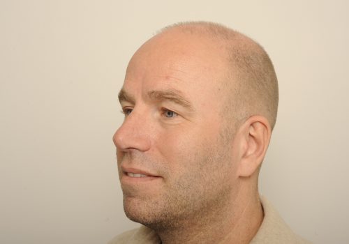 Voor de ooglidcorrectie en wenkbrauwlift Gido