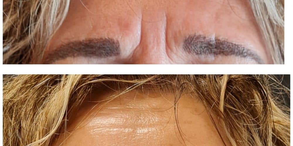Fronsrimpel Botox - Kim de Weijer