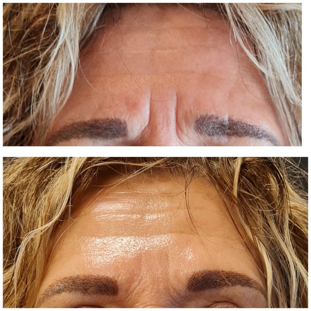 Fronsrimpel Botox - Kim de Weijer