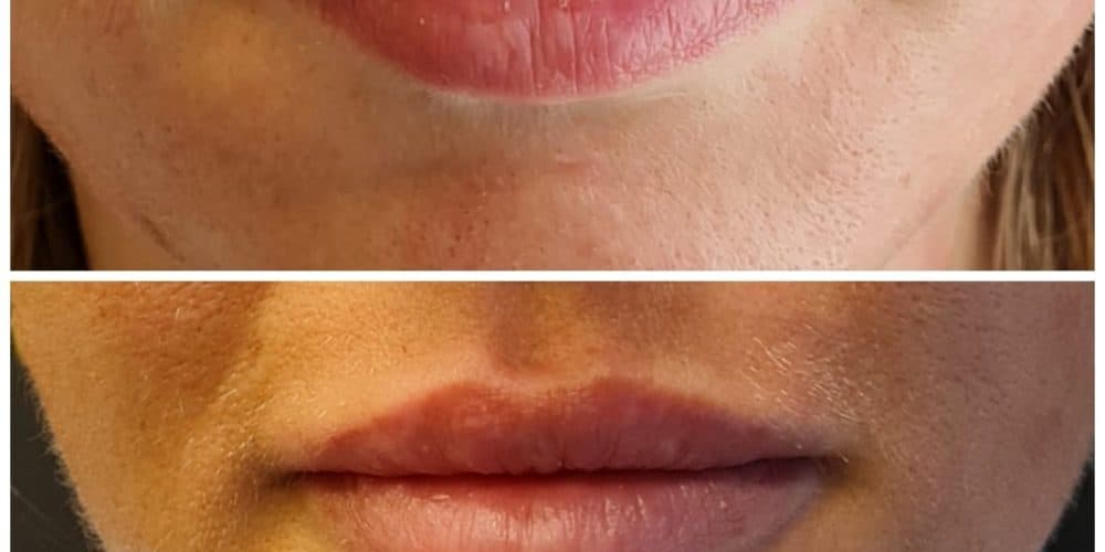Lippen opvullen - lip fillers - Kim de Weijer