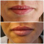 Lippen opvullen - lip fillers - Kim de Weijer