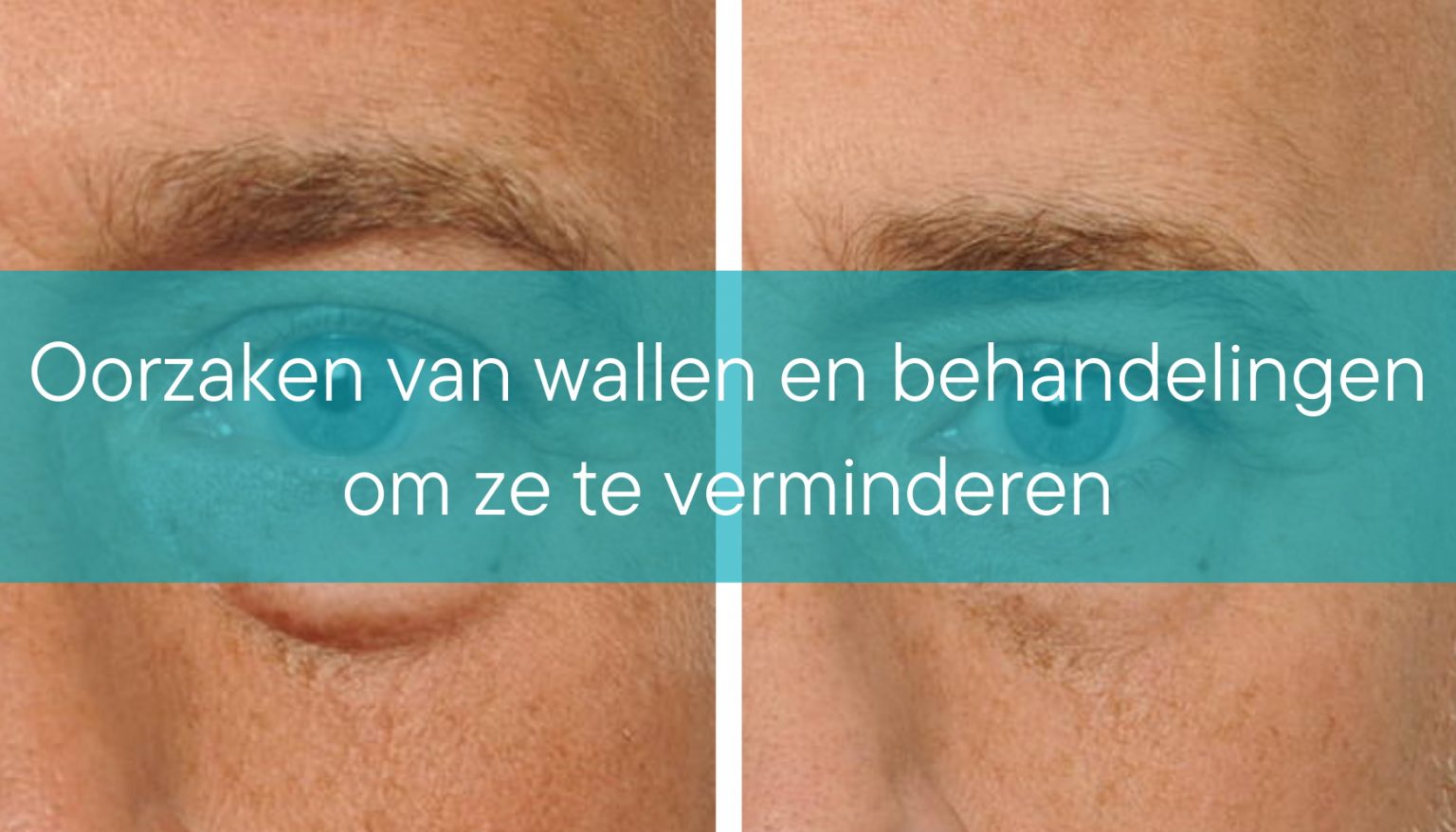 Wat Kun Je Doen Tegen Wallen