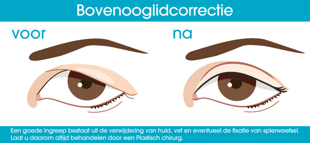 Bovenooglidcorrectie - ooglidcorrectie bovenste oogleden - ooglidcorrectie