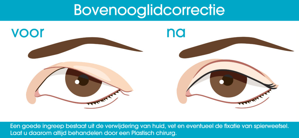 Bovenooglidcorrectie, ooglidcorrectie bovenste oogleden, ooglidcorrectie