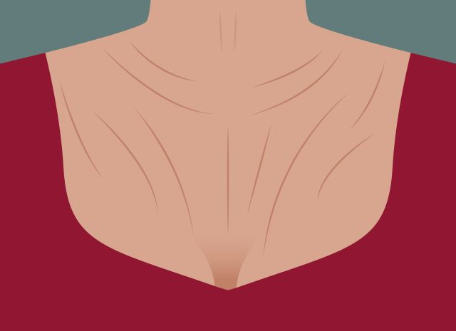 Decolleté rimpels - verjonging