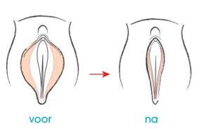 Schaamlipcorrectie - schaamlipverkleining - labiacorrectie - labiaplastie