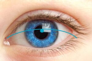 Ooglidcorrectie vergoeding - bovenooglidcorrectie vergoeding