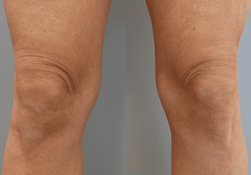 profhilo body voor