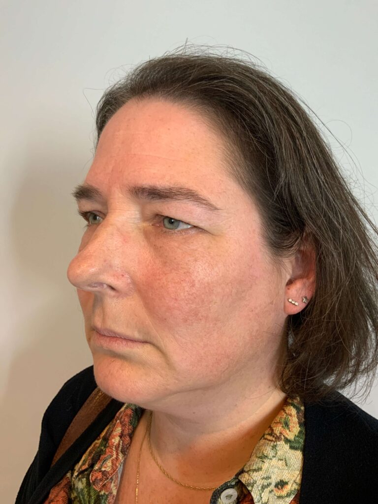 Bovenooglidcorrectie voor 2024, zware oogleden