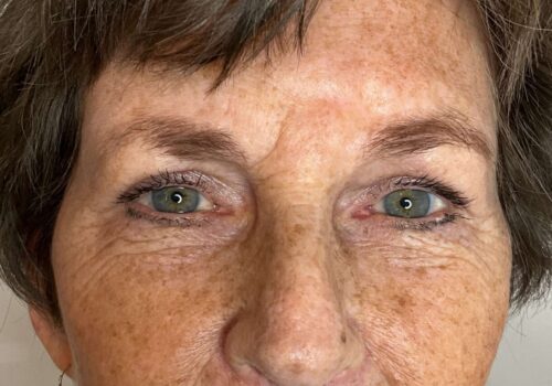 Bovenooglidcorrectie na