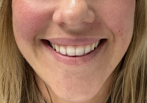 Gummy smile met fillers na 1