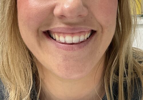 Gummy smile met fillers voor 1