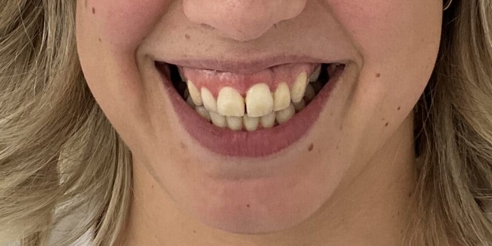 Gummy smile voor, baby botox, mini botox, tandvleeslach