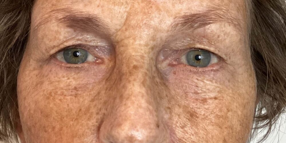 Bovenooglidcorrectie voor