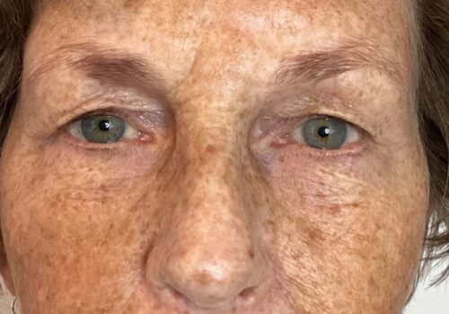 Bovenooglidcorrectie voor