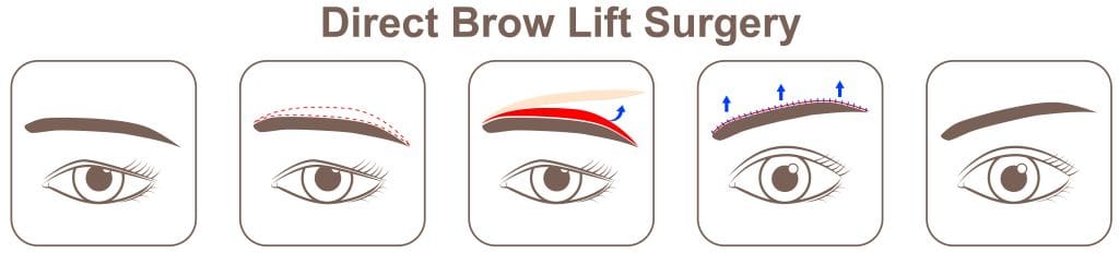 Directe wenkbrauwlift ABC Clinic