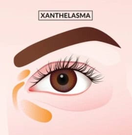 xanthelasma